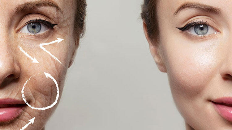 Kırışık gideren yöntem: Endopeel