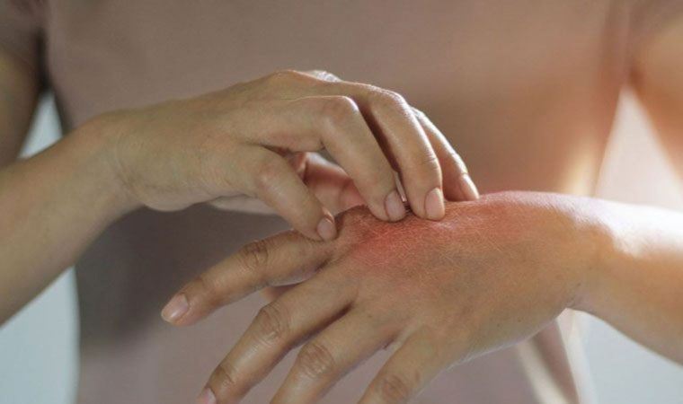 Uzmanından ‘uyuz böceği’ uyarısı: Deriyi istila ederek rahatsızlık oluşturuyor